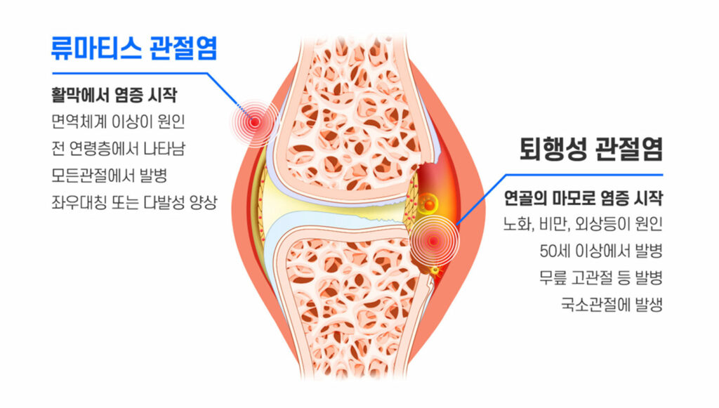 류마티스관절염 - 세종스포츠정형외과의원