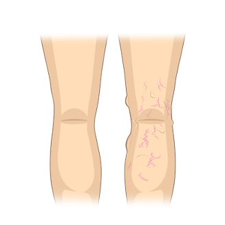 L1