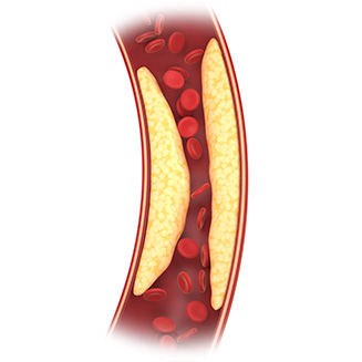 internal hbp