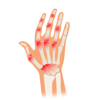 internal rheumatism