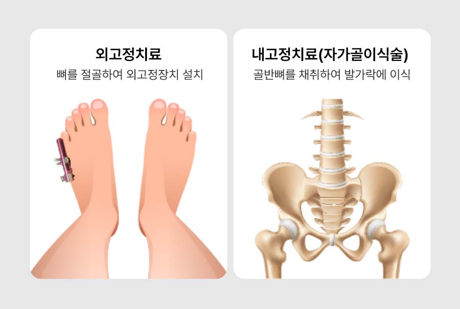 re단지증 - 세종스포츠정형외과의원