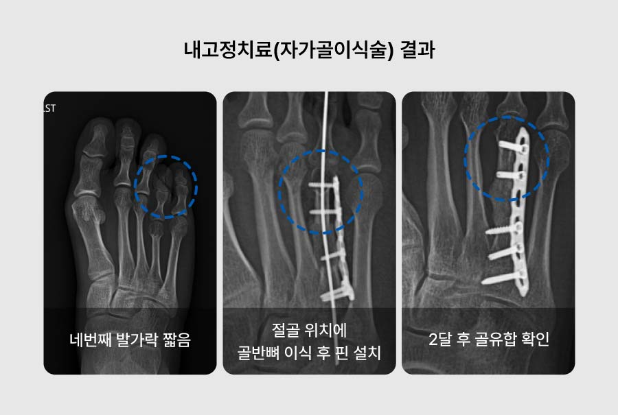 re단지증 - 세종스포츠정형외과의원