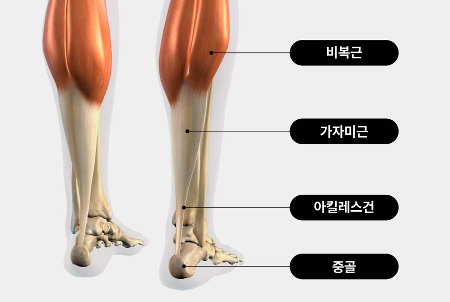 re 아킬레스건염 2 acl1