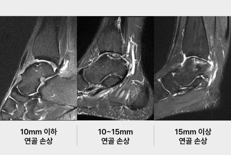 re발목연골손상 - 세종스포츠정형외과의원