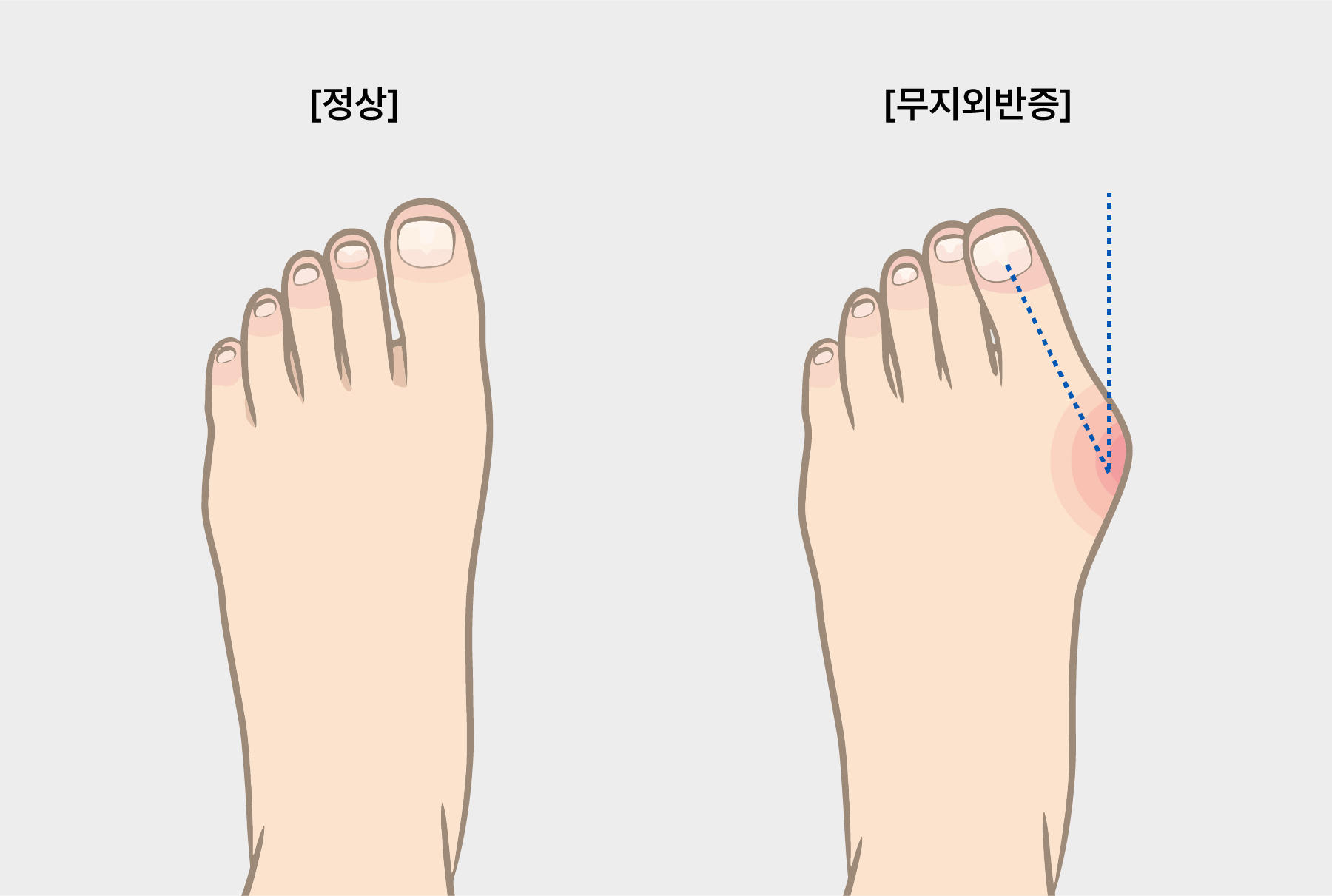 질환페이지리퍼블리싱 1 HalV 01 1